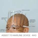 Assist to Hairline Device (AHD) - Image 3